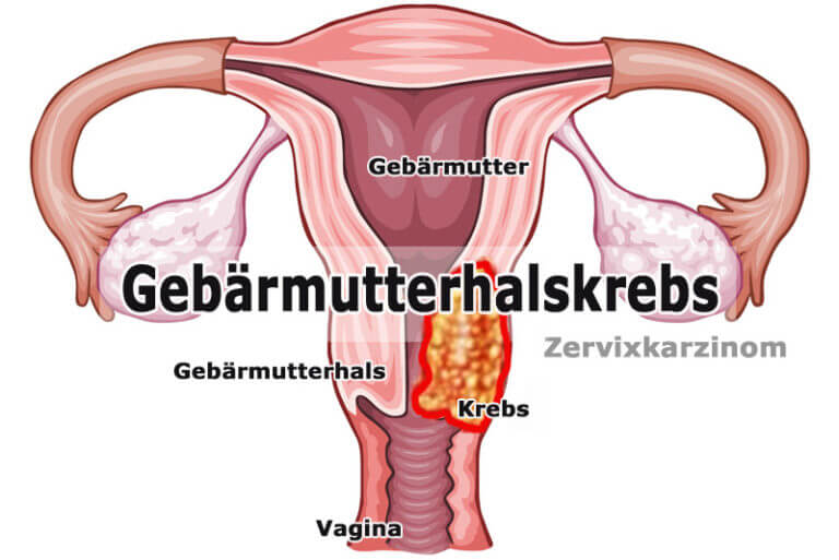 Gebärmutterhalskrebs Was ist das gesund co at