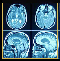 Gehirnaktivität bei Alzheimer Patienten / CT