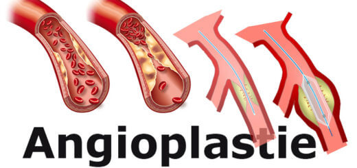 Angioplastie bei Arteriosklerose