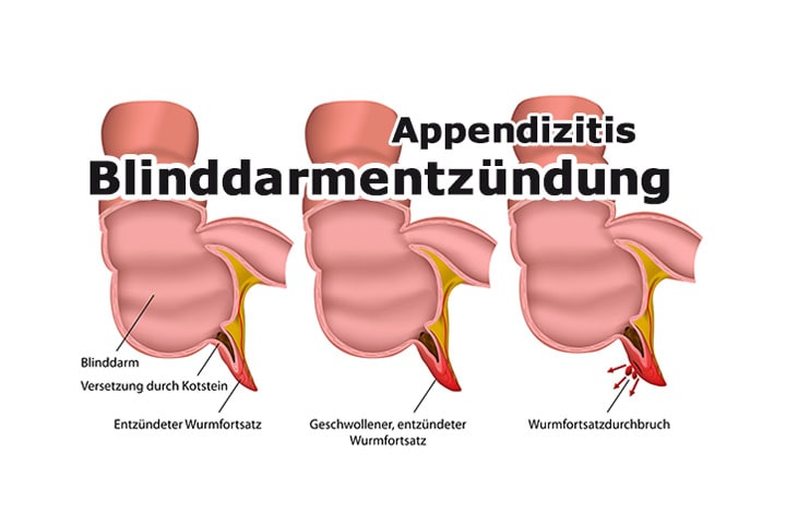 Blinddarmentzündung | Appendizitis