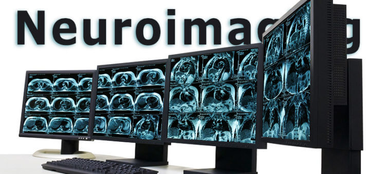 Neuroimaging – Bilder aus dem Gehirn