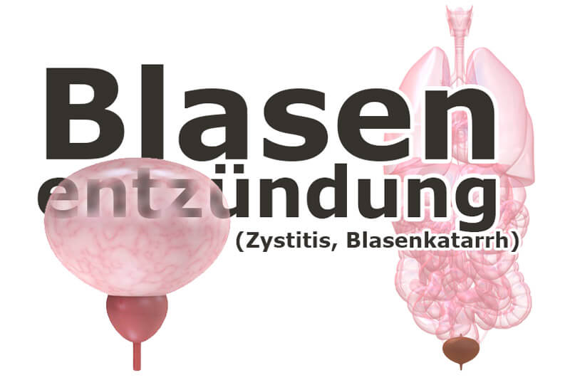 Blasenentzündung (Zystitis, Blasenkatarrh)