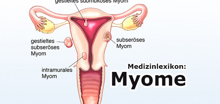 Medizinlexikon: Myom