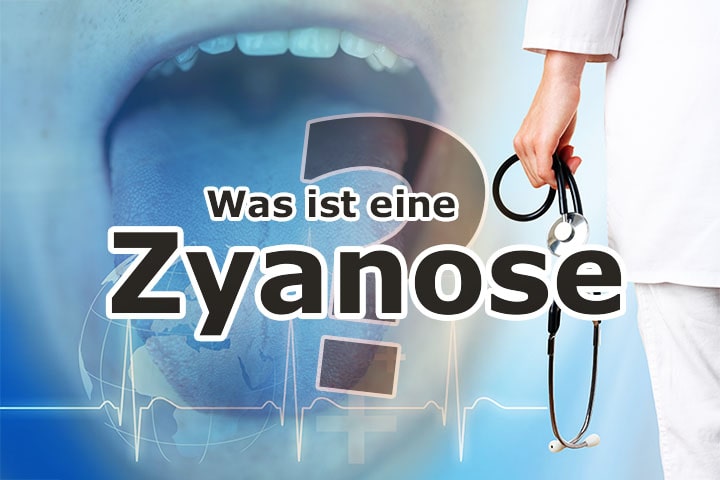 Medizinlexikon: Zyanose
