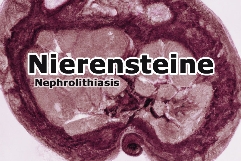 Abbildung von Nierensteinen (Nephrolithiasis)