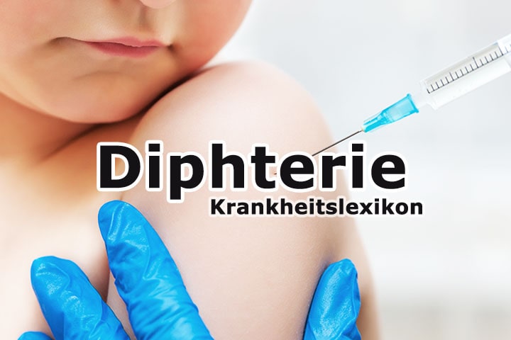 Diphterie | Krankheitslexikon