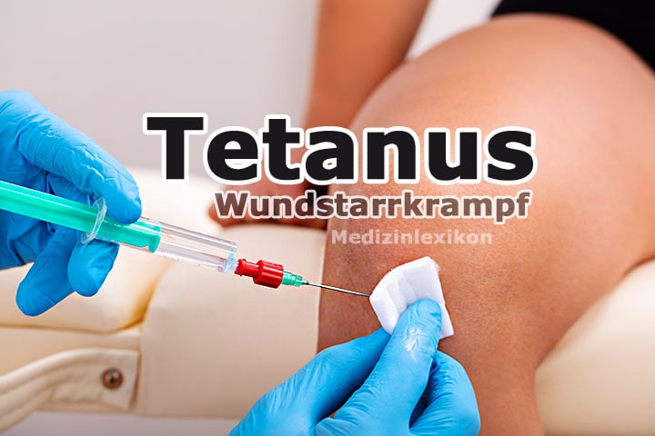 Tetanus (Wundstarrkrampf) | Medizinlexikon