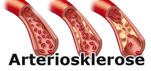 Arteriosklerose (Arterienverkalkung)| Krankheitslexikon