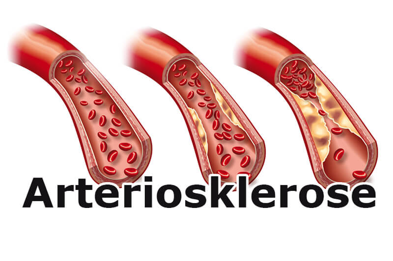 Arteriosklerose eines Blutgefäßes