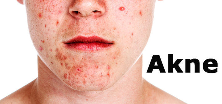 Akne | Krankheitslexikon