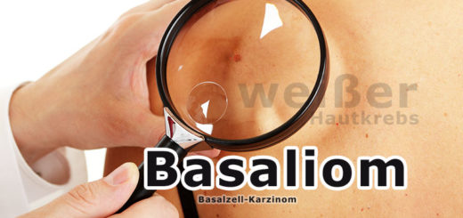 Basaliom (weißer Hautkrebs) | Krankheitslexikon