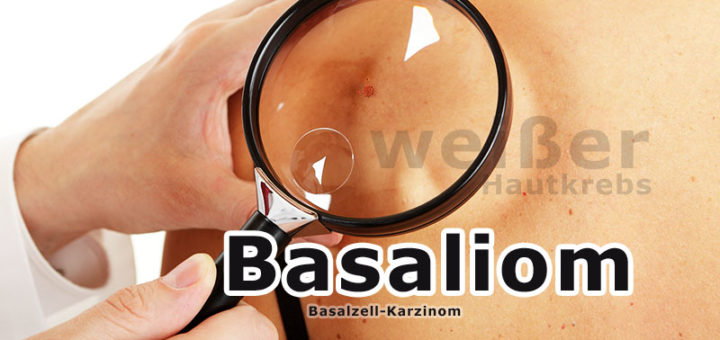 Basaliom (weißer Hautkrebs) | Krankheitslexikon