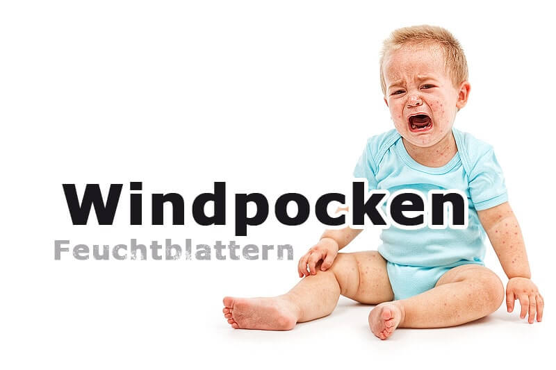 Windpocken (Feuchtblattern) | Kinderkrankheiten