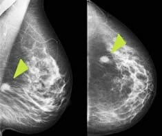 Mammografie, Brustkrebs