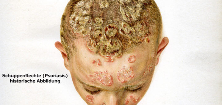 Psoriasis auf der Kopfhaut -