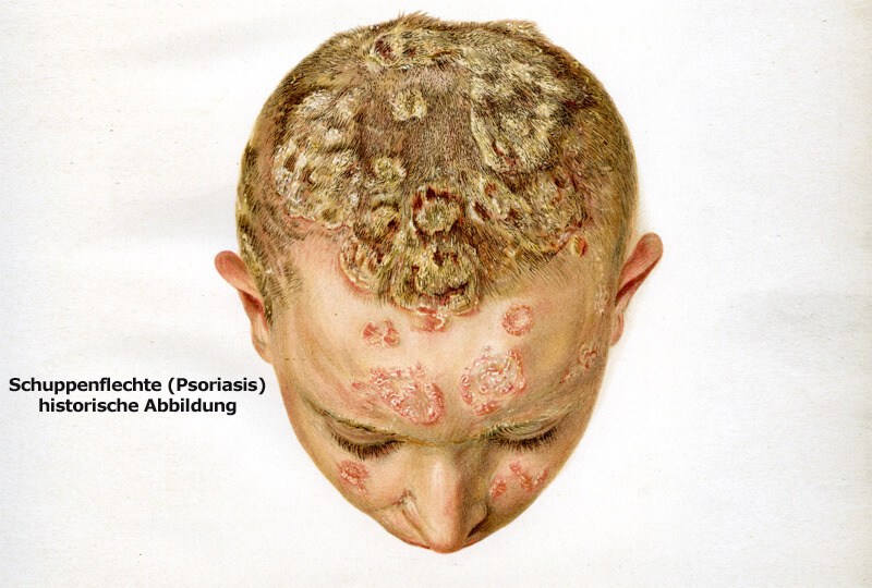 Psoriasis auf der Kopfhaut