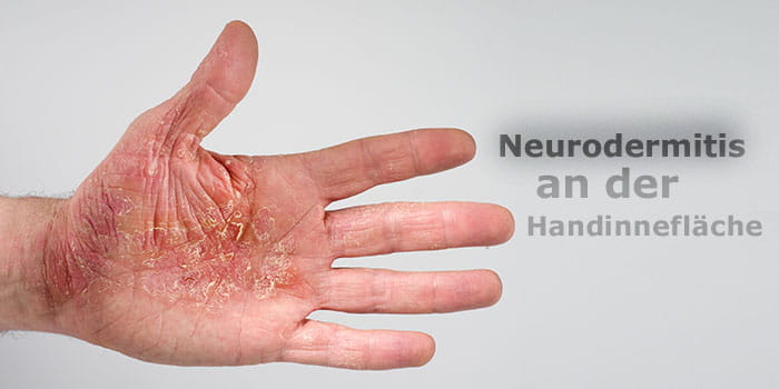 Neurodermitis, auch atopische Dermatitis oder atopisches Ekzem genannt