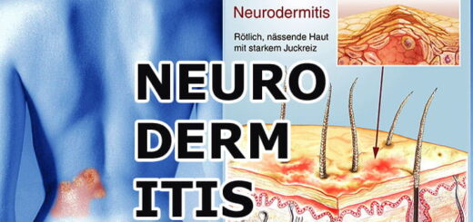 Neurodermitis (Atopische Dermatitis) – Ursachen, Symptome, moderne Therapien und Hilfe für Betroffene