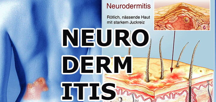 Neurodermitis (Atopische Dermatitis) – Ursachen, Symptome, moderne Therapien und Hilfe für Betroffene