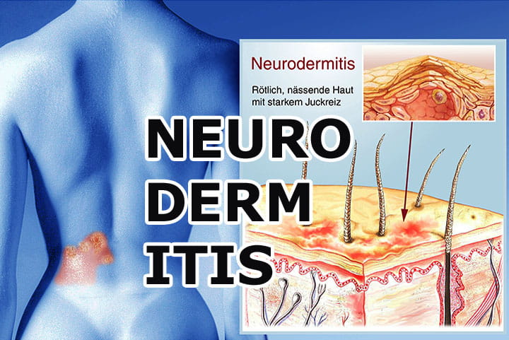 Neurodermitis (Atopische Dermatitis) – Ursachen, Symptome, moderne Therapien und Hilfe für Betroffene