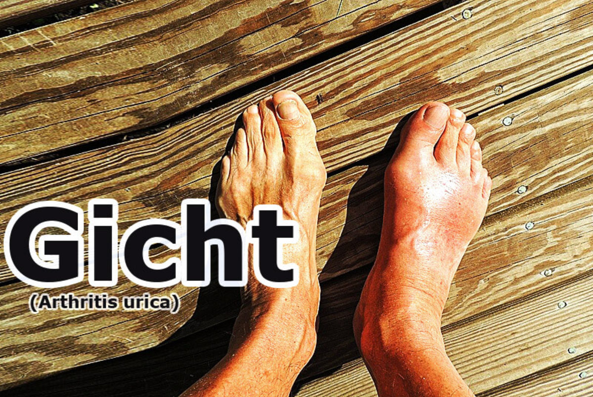 Gicht (Arthritis urica) | Krankheitslexikon » 