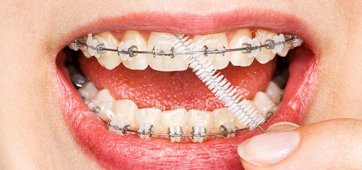 Zahnspangen richtig pflegen