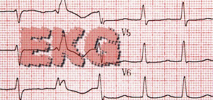 Was ist ein EKG (Elektrokardiogramm)?