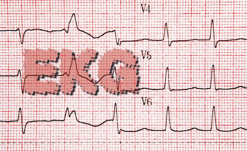 EKG - Elektrokardiogramm