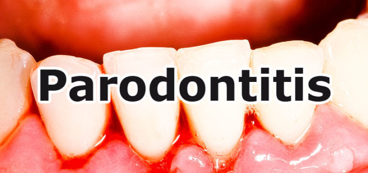 Parodontitis - Zahnfleischbluten