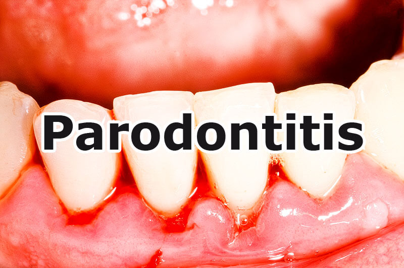 Parodontitis - Zahnfleischbluten