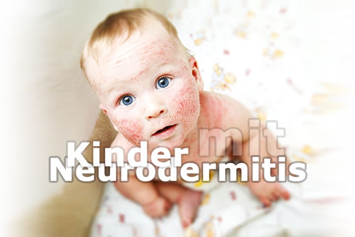 Die 5 besten Tipps für Kinder mit Neurodermitis