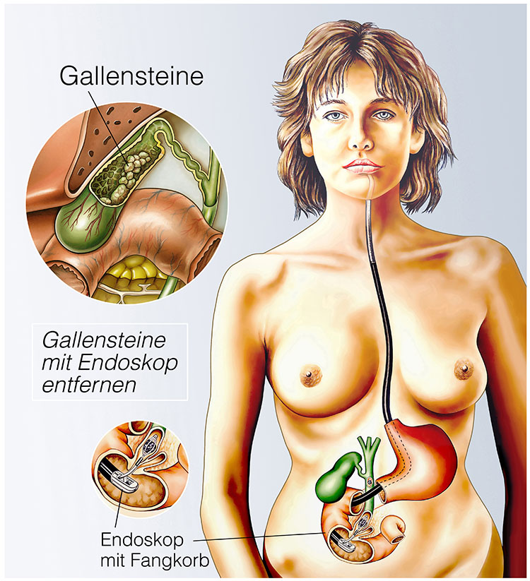 Gallensteine mit Endoskop entfernen