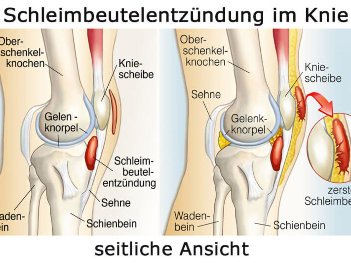 Lange dauert schleimbeutelentzündung hüfte