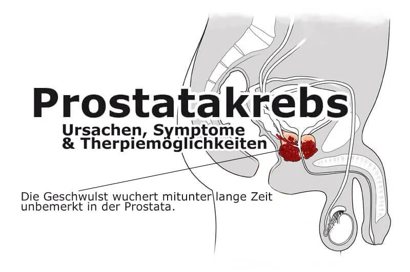 Prostatakrebs - Ursache, Symptome & Therapie