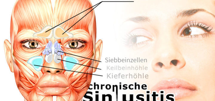 Chronische Sinusitis