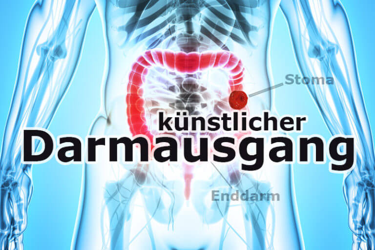 Wie Sieht Ein Künstlicher Darmausgang Aus gesund.co.at