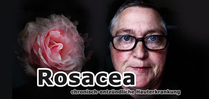 Rosacea: Ursache, Behandlung und Pflege