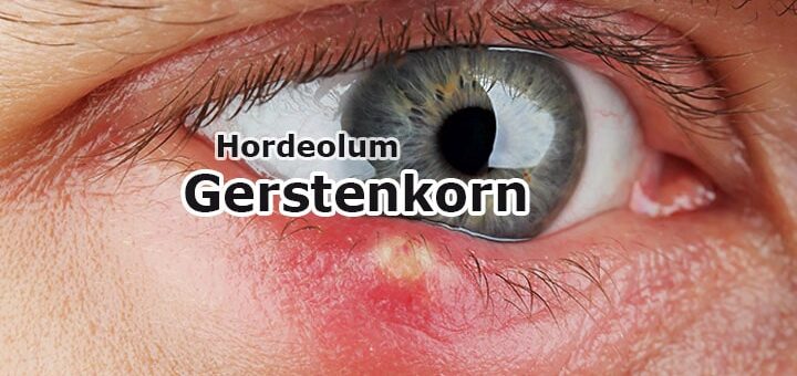 Augenentzündungen: Gerstenkorn & Hagelkorn - Ursachen & Behandlung