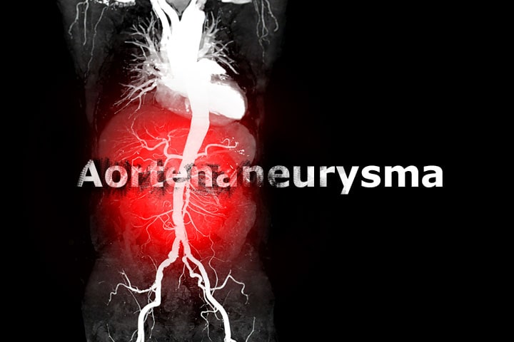 Aortenaneurysma: Ursachen, Symptome & Behandlung Aortenaneurysma | Medizinlexikon