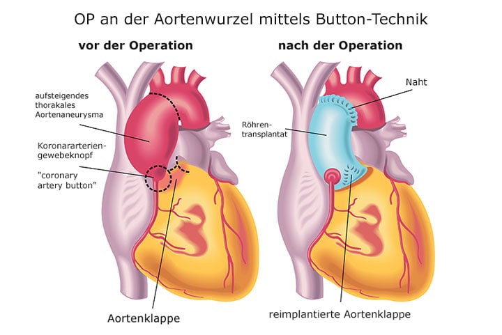 Operationstechnik bei Aortenaneurysma Operationstechnik bei Aortenaneurysma