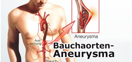 Bauchaorten-Aneurysma | Medizinlexikon