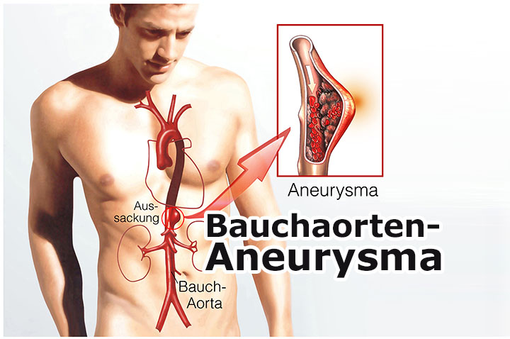 Bauchaorten-Aneurysma | Medizinlexikon