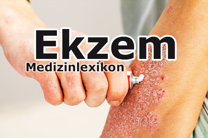 Ekzem: Formen, Ursachen, Symptome und Behandlung | Medizinlexikon